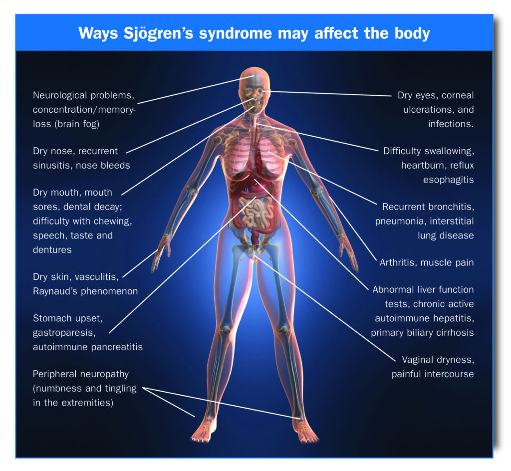 Treatment for Sjogren's Syndrome - Philadelphia Holistic Clinic - Dr. Tsan