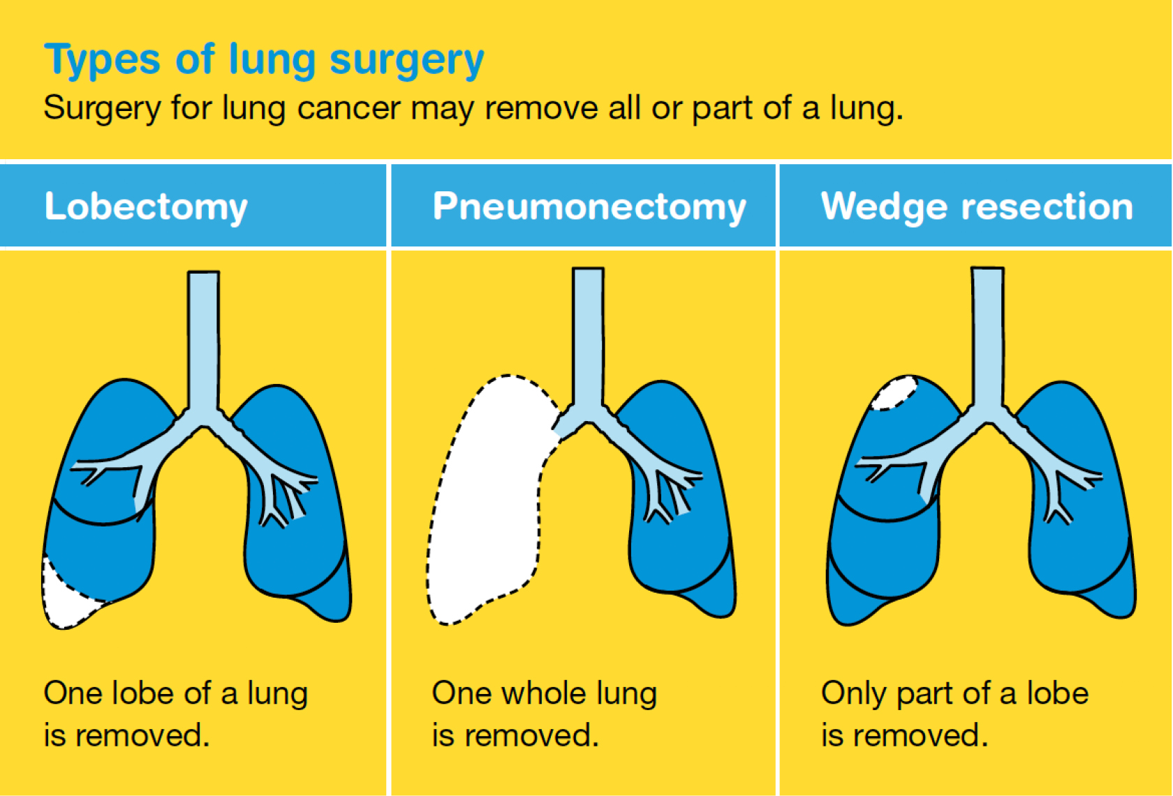 Surgery as a treatment for lung cancer