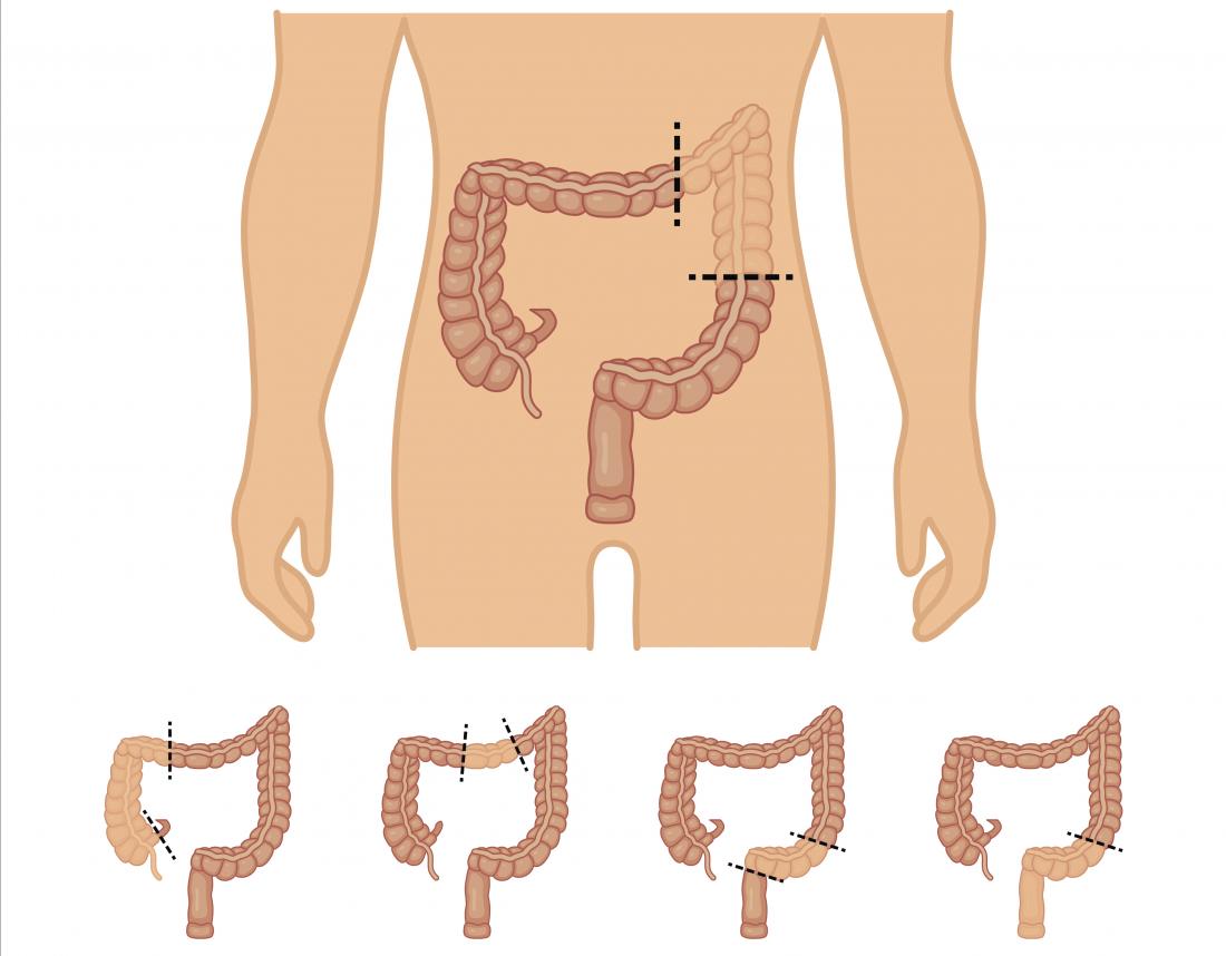 IBD