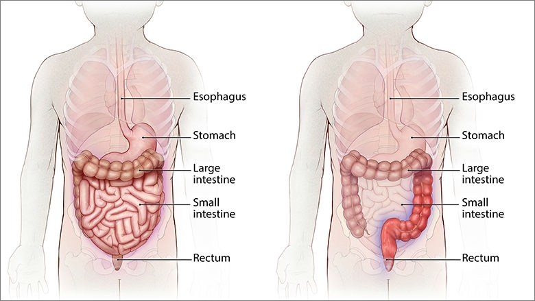 What is ulcerative colitis?