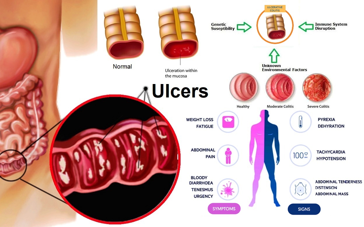 uc symptoms