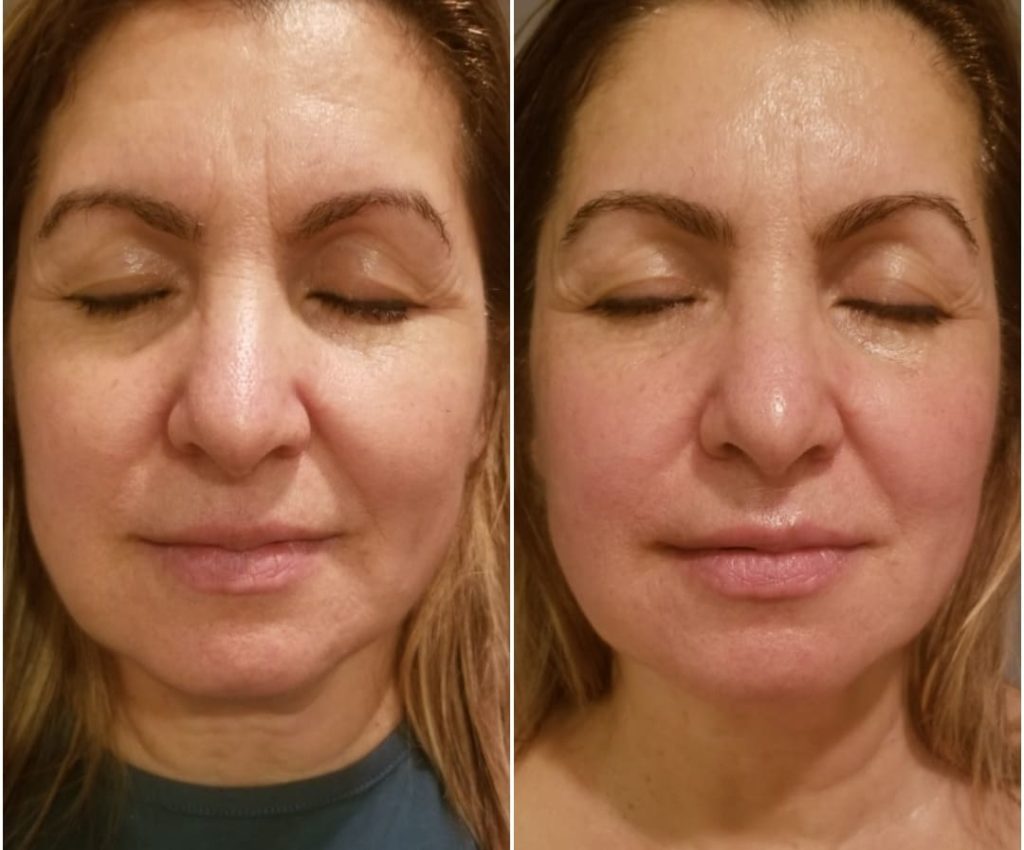 Buccal Massage