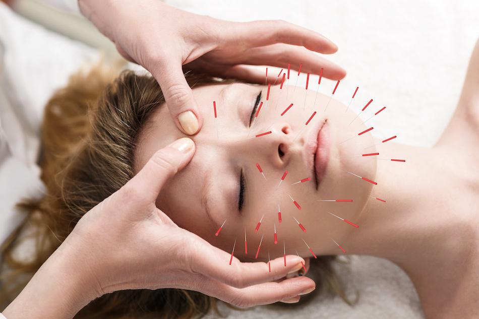 Facial acupuncture