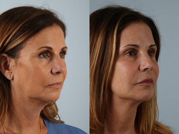 Facial rejuvenation