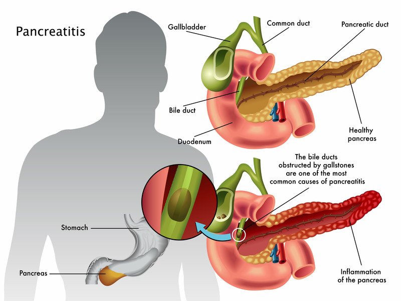 A natural treatment for pancreatitis