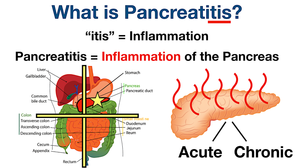 What is pancreatitis