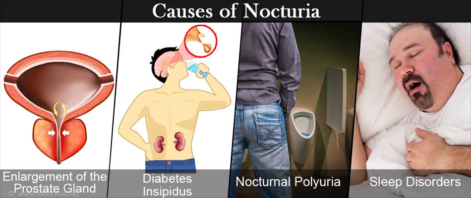causes of nocturiacauses of excessive nighttime urination frequency