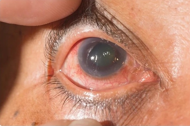 Injury-related glaucoma
