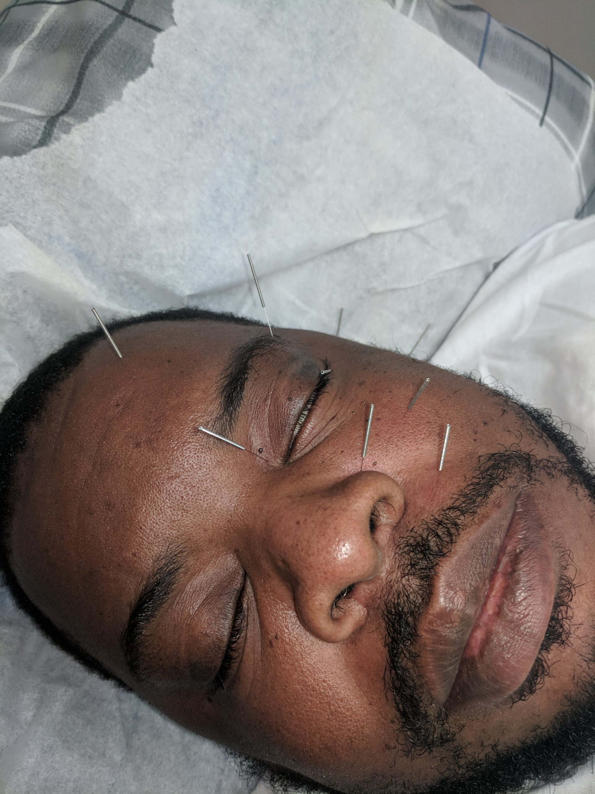 Acupuncture - natural treatment for glaucoma