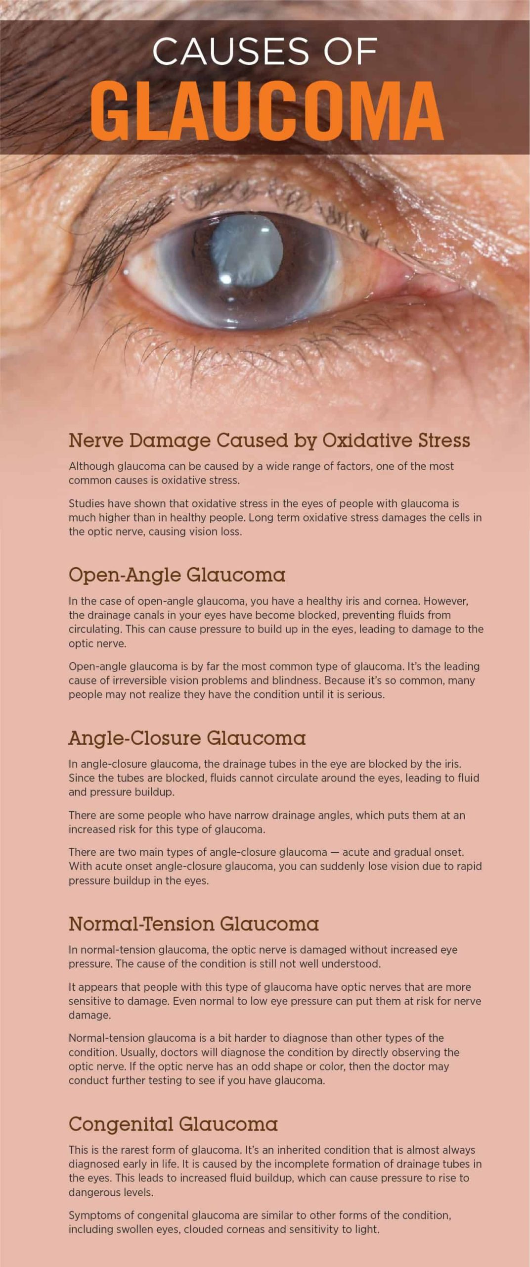 Caauses of Glaucoma
