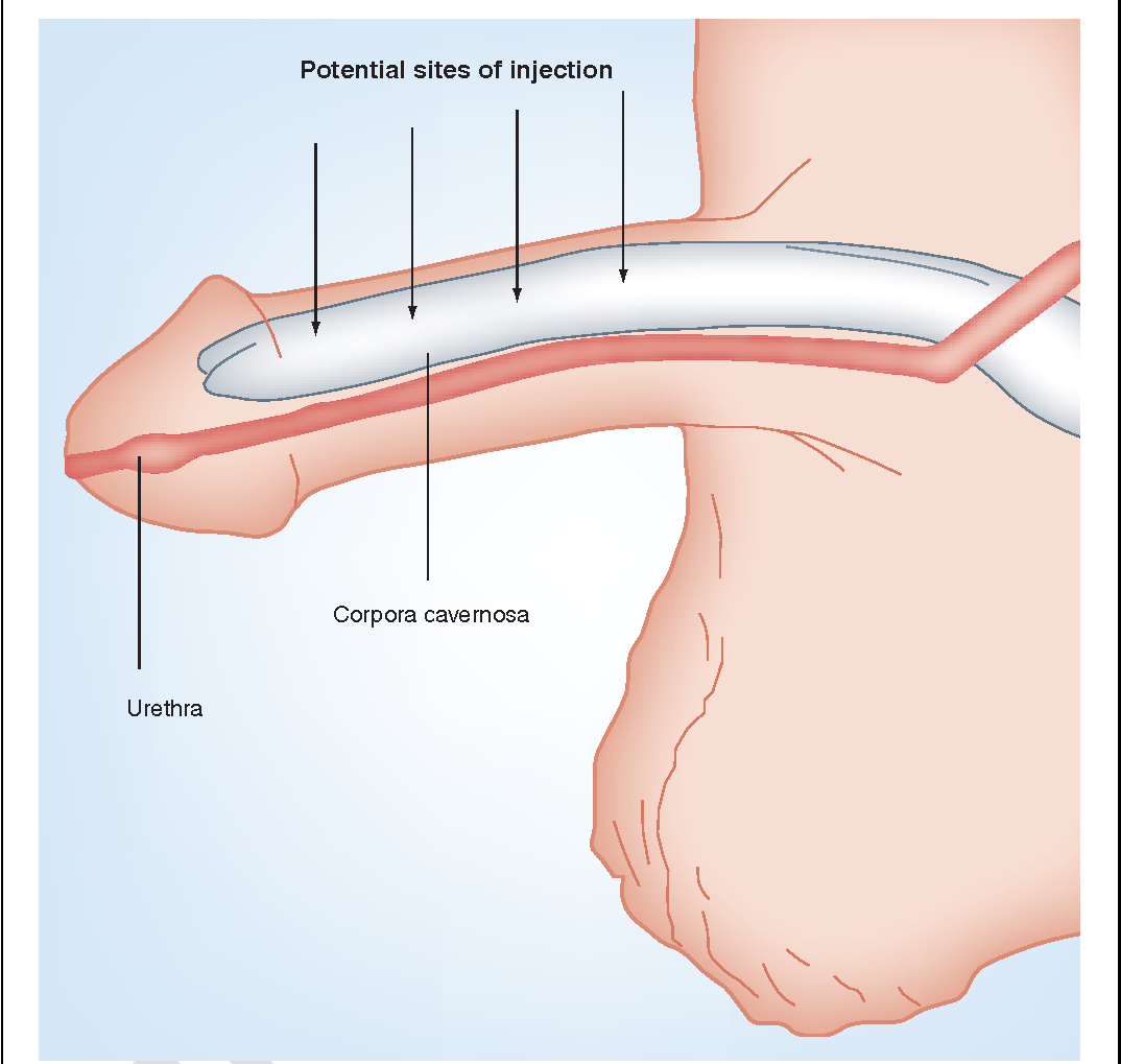 ntracavernosal Injection for ED treatments