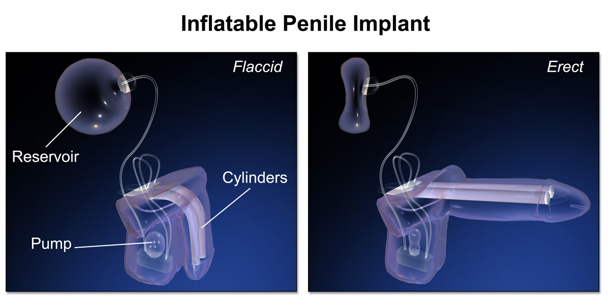 Penile Implant for ED treatments