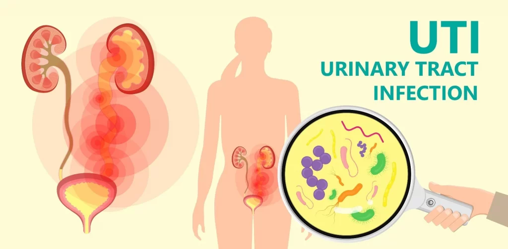 Home remedies for UTIs
