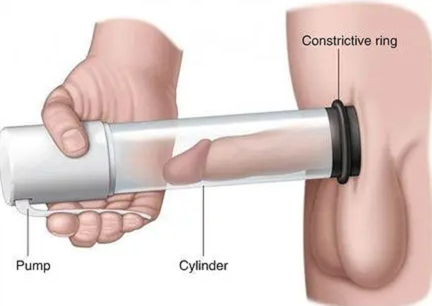 Vacuum Devise for ED Treatments