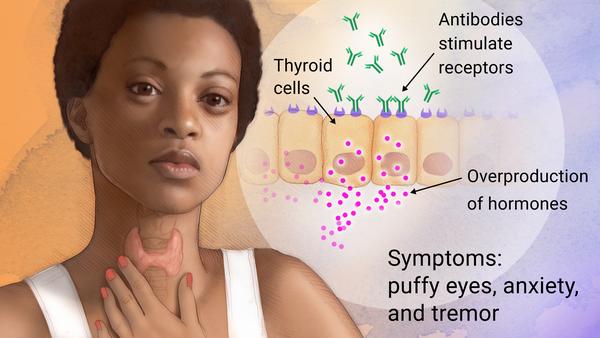 Graves disease hyperhytoridism