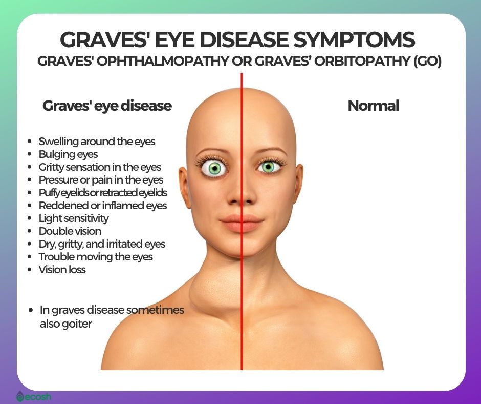 Symptoms of Graves disease