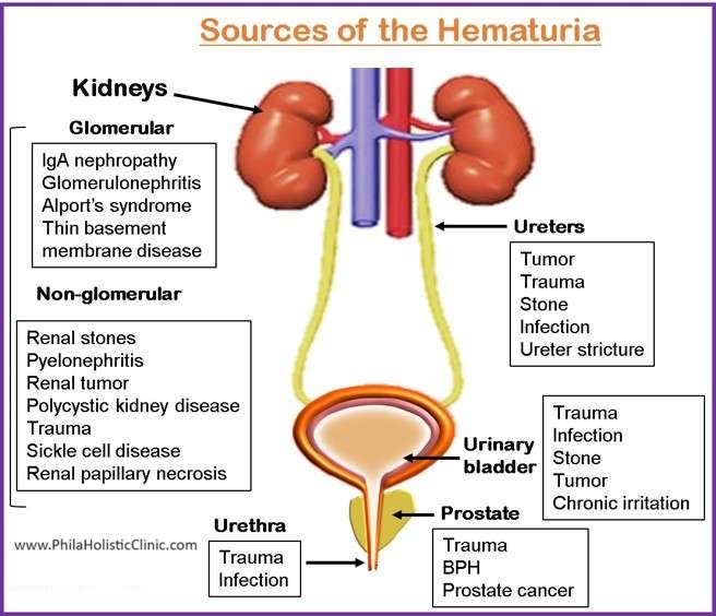 Sources of blood in urine