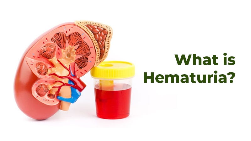 What is hematuria