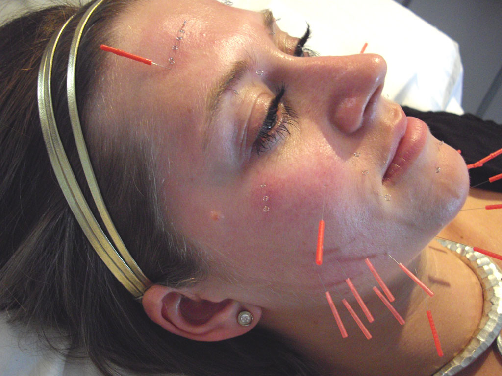 Acupuncture for hirsutism