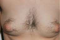 Hirsutism