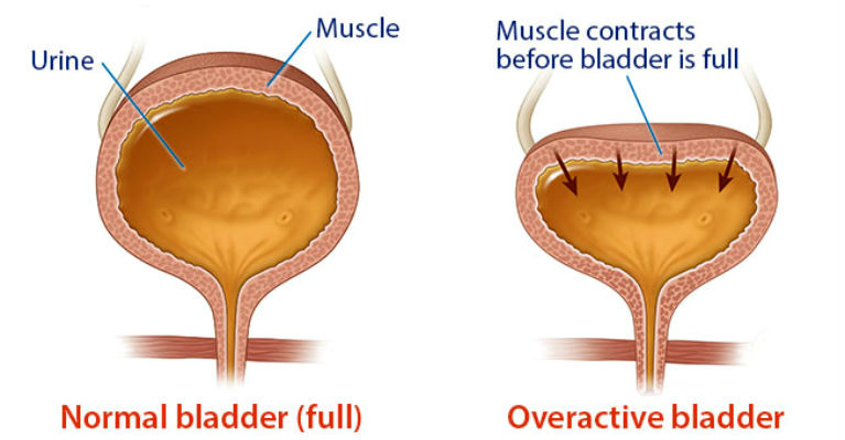 OverActive Bladder