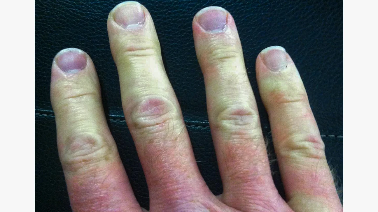 Raynauds phenomenon
