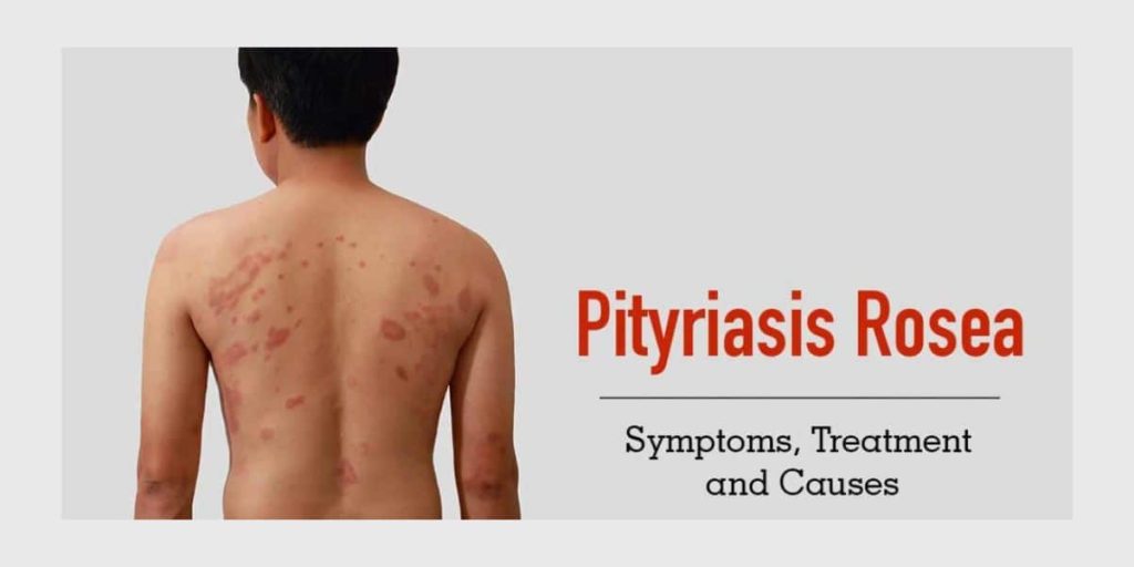 Pityriasis Rosea Symptoms Causes and Treatment