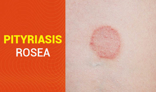 Pityriasis