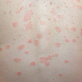 Pityriasis rosea