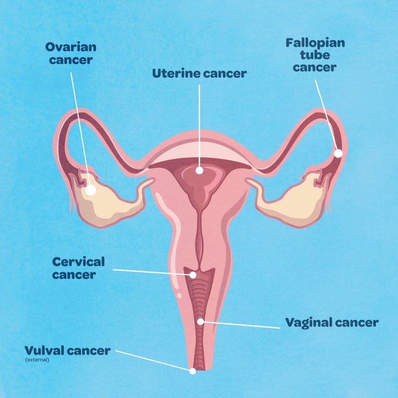 Malignant processes in uterus, ovaries and tube