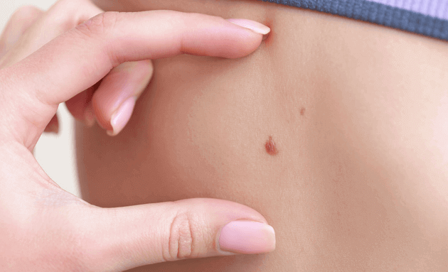 Moles - possible sign of skin cancer
