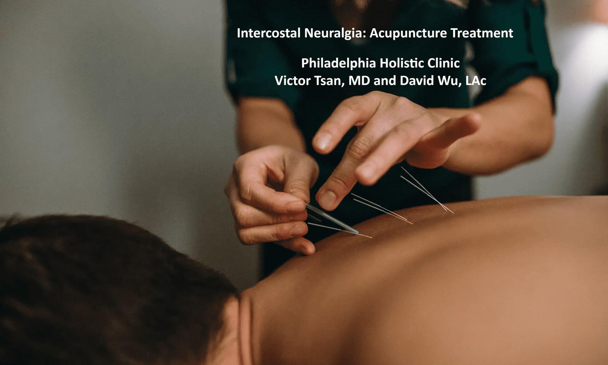 Acupuncture for Intercostal Neuralgia