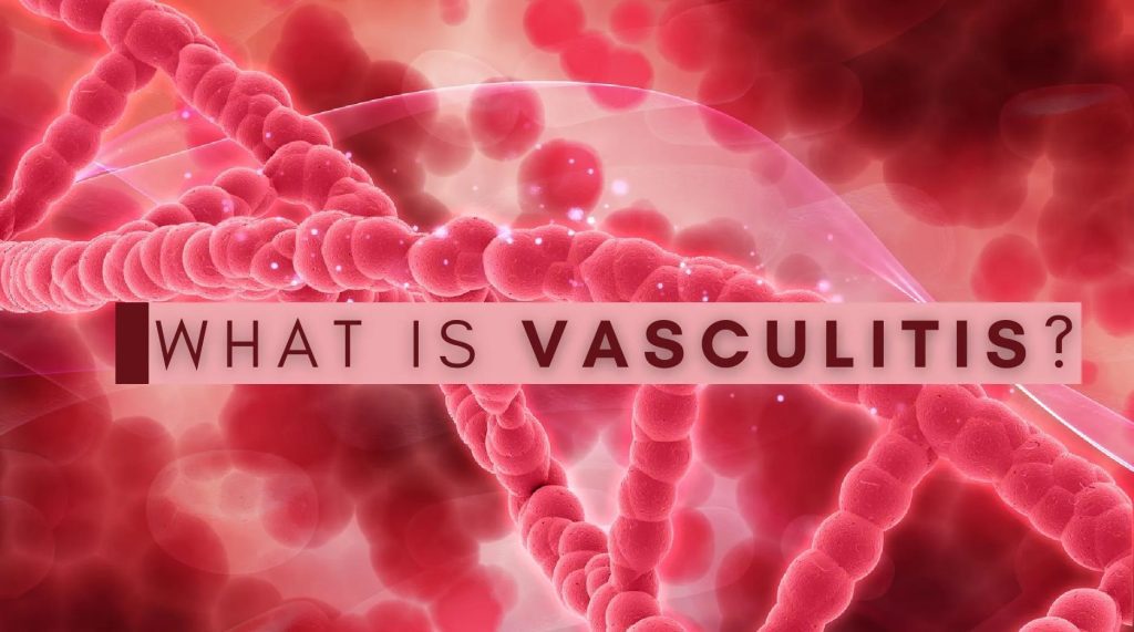 What is Vasculitis