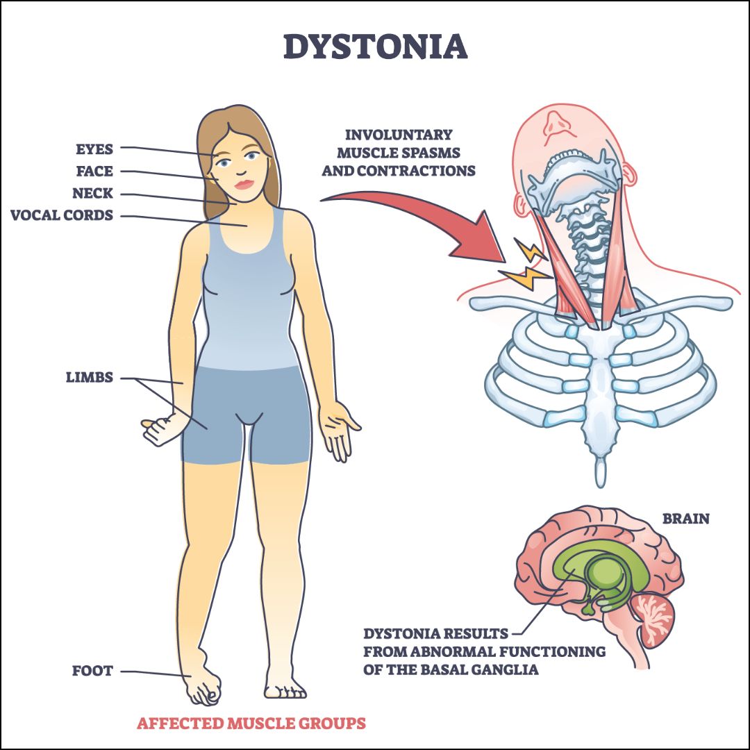 Dystonia affects different groups of muscles