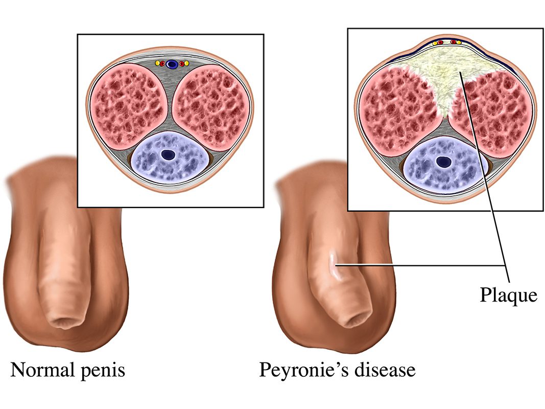 Symptoms of IPP