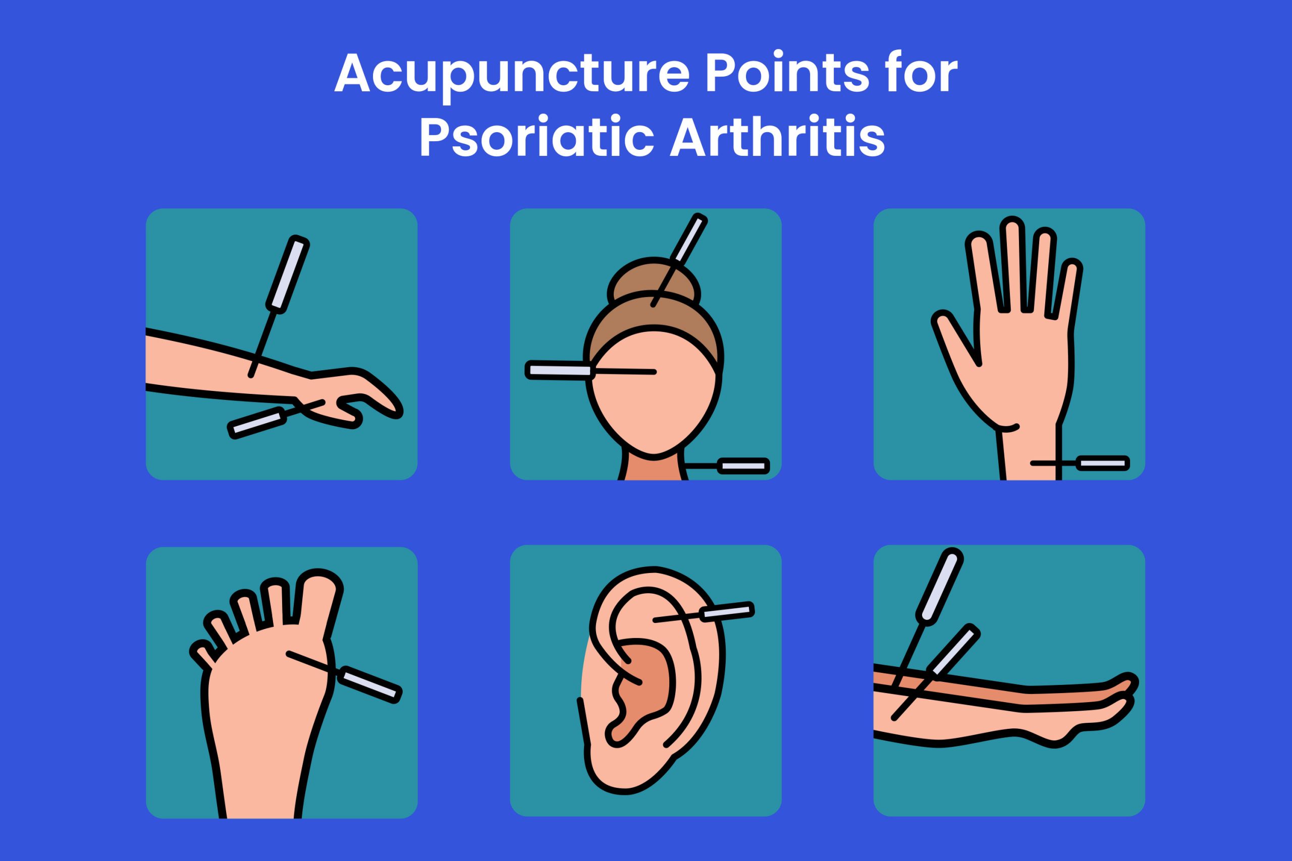 Acupuncture for PsA