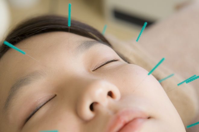 Acupuncture