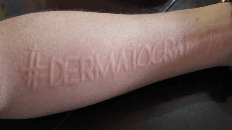 Dermatographia Disease Understanding The Skin Disorder Philadelphia Holistic Clinic