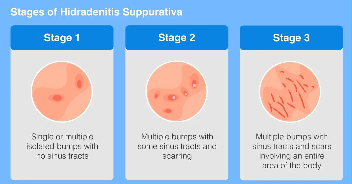 Phases of Hidradenitis Suppurativa