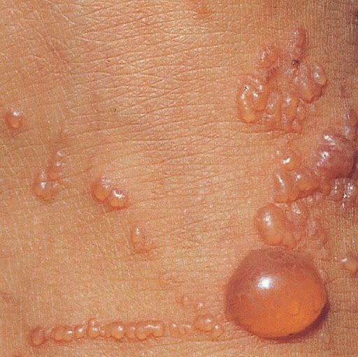 Poison ivy rash