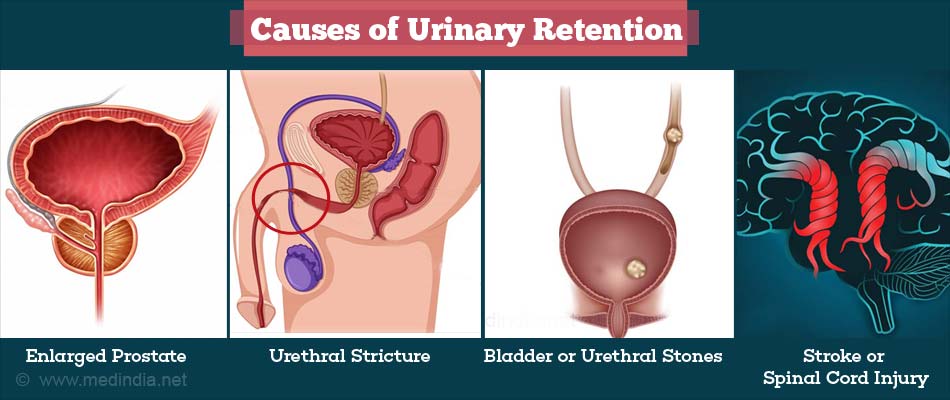 causes of urinary retention