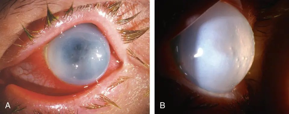Acute Hydrops
