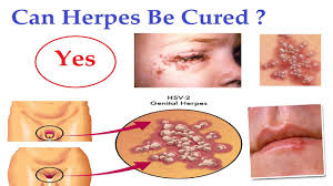 Can HPV be cured?