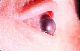 Corneal Ectasia