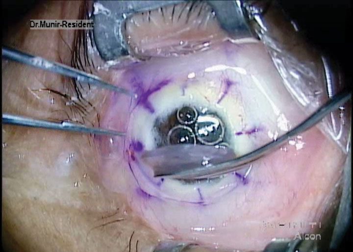 Deep anterior lamellar keratoplasty