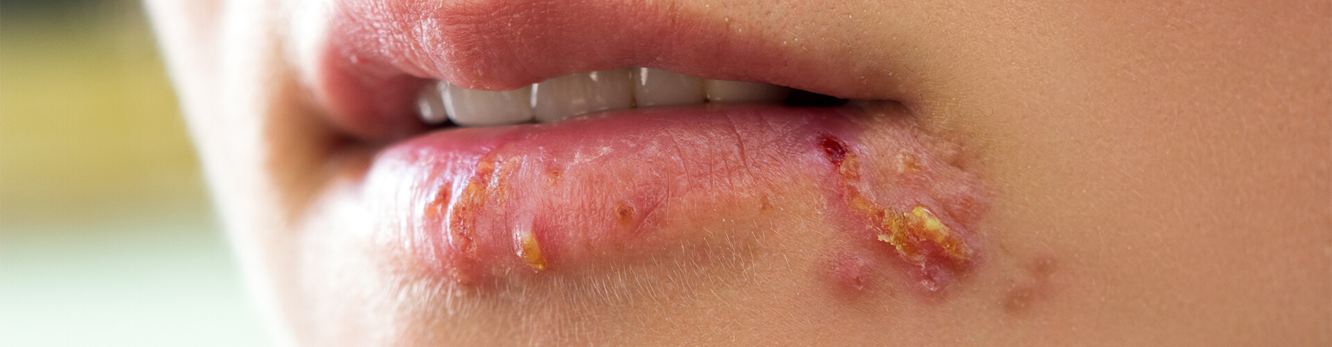 Herpes on lips