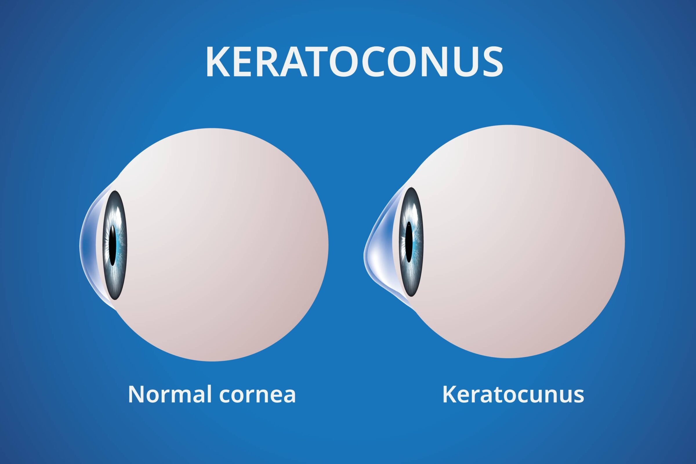 Keratoconus