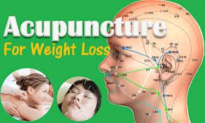 Weight Loss Acupuncture