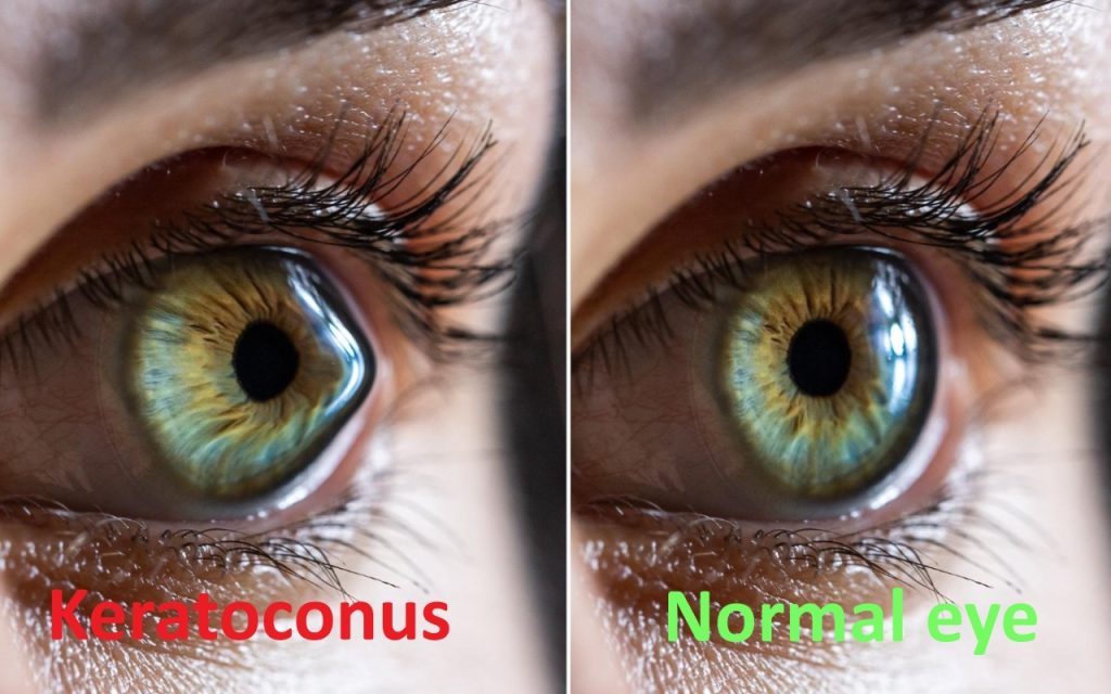 keratoconus