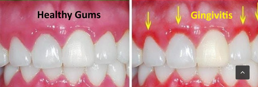 Gingivitis